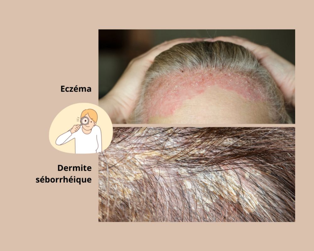 Eczéma ou dermite séborrhéique : comment faire la différence ?