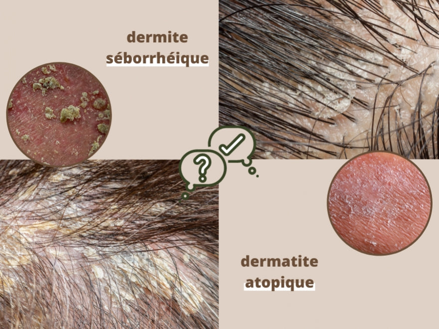 Dermite séborrhéique ou dermatite atopique : comment choisir le bon soin bio