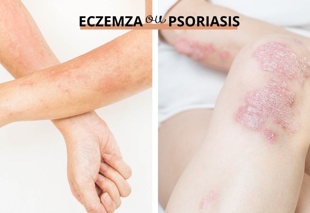 Eczéma ou Psoriasis : comment faire la différence ?